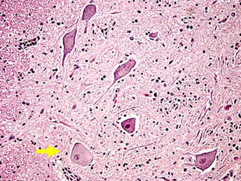 Histopatología de la poliomielitis paralizante