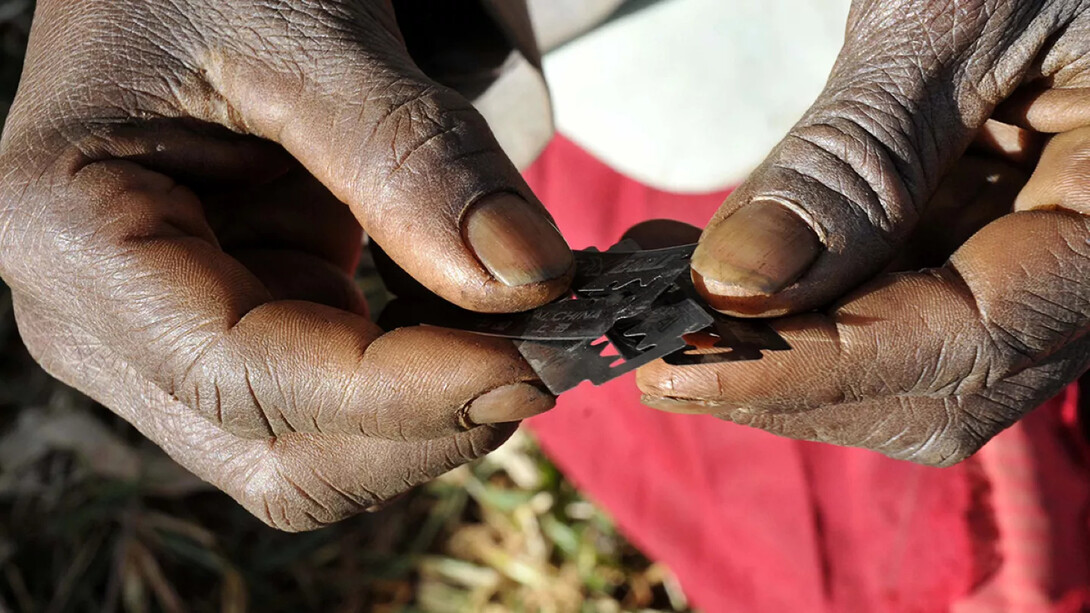 Infibulation. Bien que la pratique des mutilations génitales féminines soit interdite par la loi dans de nombreux pays, il existe une minorité de médecins qui les pratiquent clandestinement